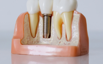 Implantes Dentales con Enfoque Integrativo: Restaurar tu Sonrisa, Sanar tu Confianza