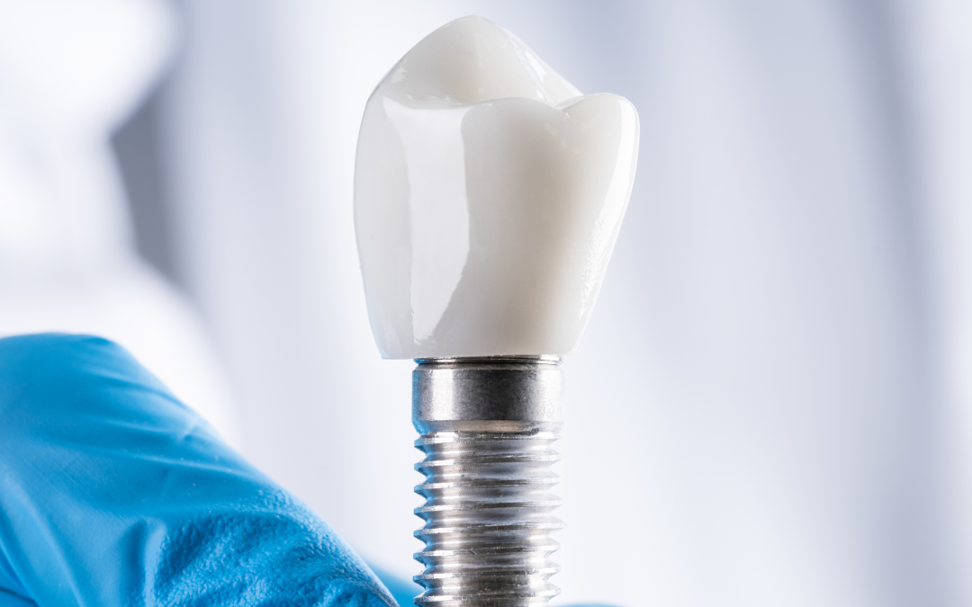 ¿Por qué un implante dental puede ser rechazado? Lo que nadie te cuenta (y deberías saber)